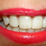 Spôsoby bielenia zubov